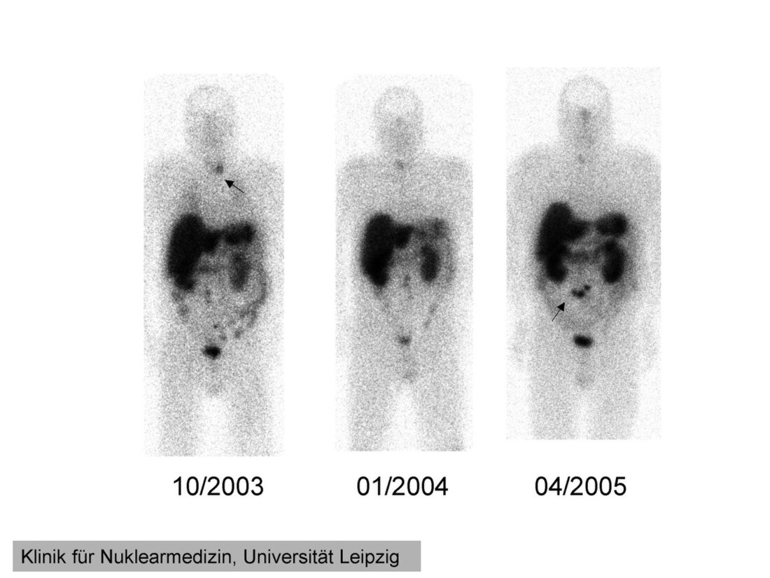 Octreotide scan