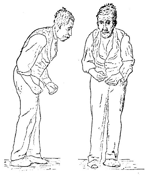 File:Sir William Richard Gowers Parkinson Disease sketch 1886.jpg