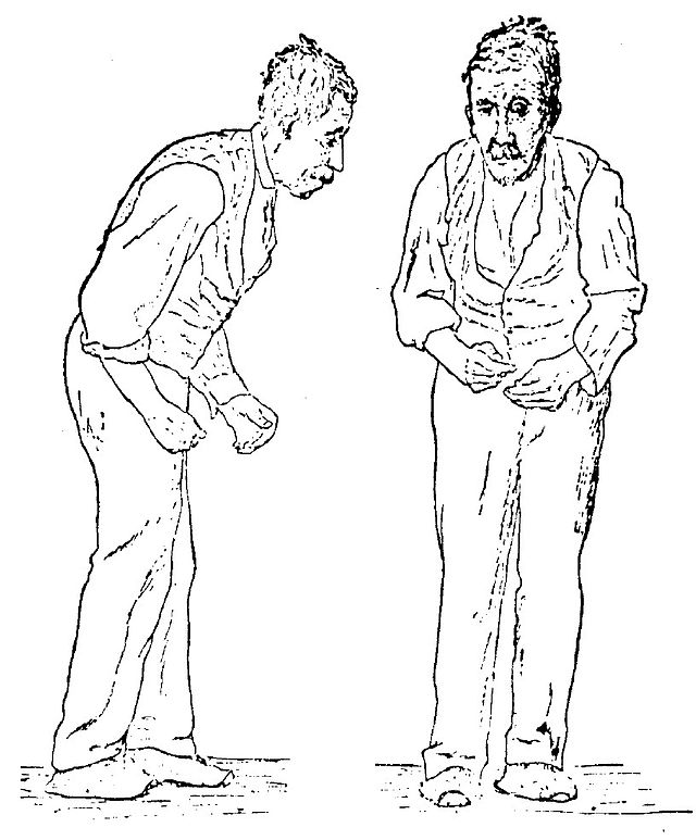 Illustration of Parkinson's disease by William Richard Gowers from A Manual of Diseases of the Nervous System in 1886.