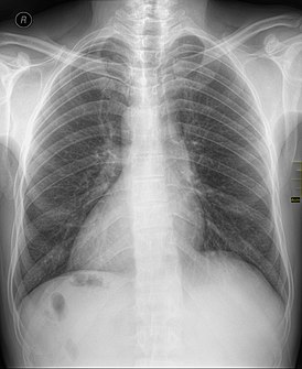 Декстрокардия в рамках situs inversus на рентгенограмме органов грудной клетки.