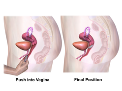 Vaginal Ring Application (Steps 2 & 3).png