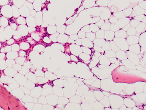 Hypocellular bone marrow