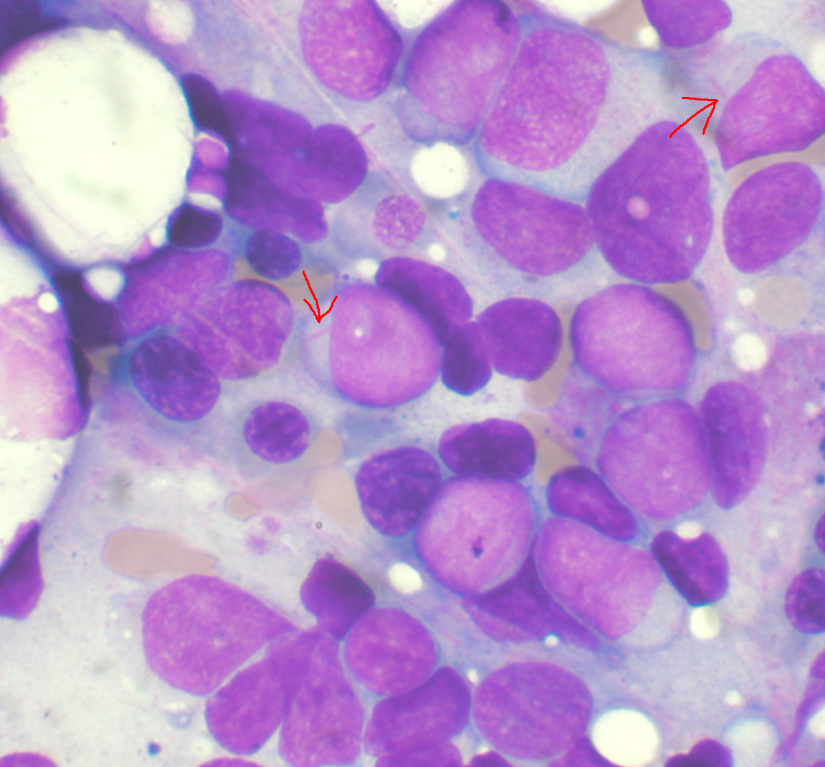 anemia x leucemia