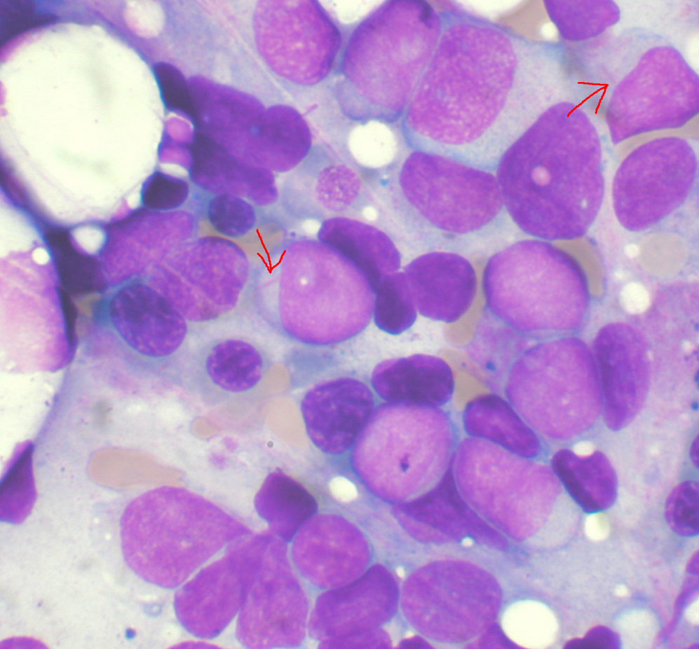 Acute Myeloid Leukemia-avatar