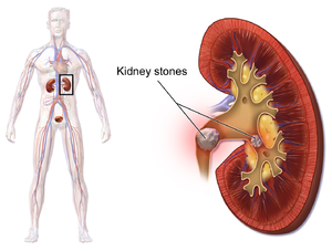 Blausen 0595 KidneyStones.png