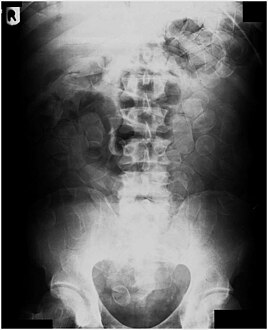 Abdominal X-ray showing small packages of cocaine swallowed by a trafficker.