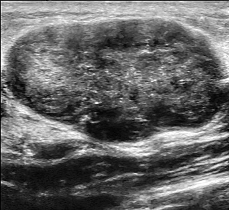 Breast US Fibroadenoma 0531094222218 Nevit.jpg