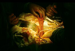 Bypass surgery lower side at the Hasharon Hospital (FL45930347).jpg