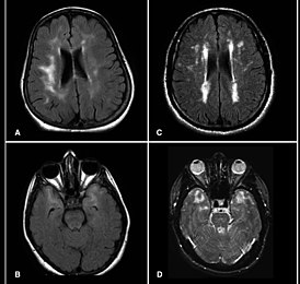 МРТ головного мозга больного синдромом CADASIL