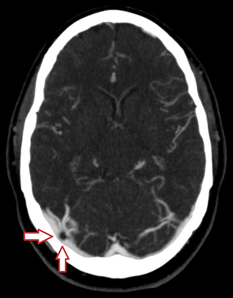 File:CT scan of a pacchionian body - transverse plane - labeled.jpg