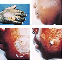 Child with cutaneous anthrax infection.jpg