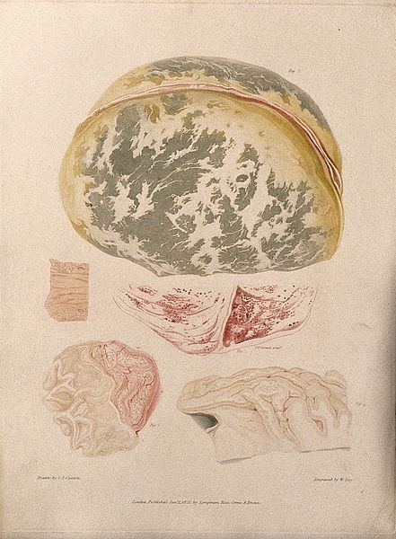 File:Four sections of diseased brain; and a section of spine. Col Wellcome V0009793EL.jpg