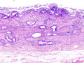 Gallbladder adenocarcinoma, HE staining