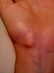 Ganglion cyst on the palmar side of the left wrist