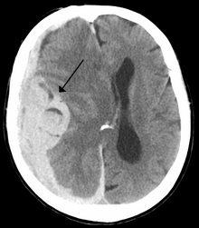 Intracranial bleed with significant midline shift.png