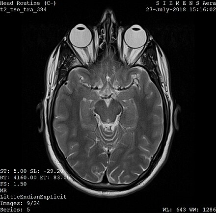 One frame of an MRI scan of the head showing the eyes and brain.