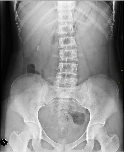 File:Medical X-Ray imaging BJM02 nevit.jpg