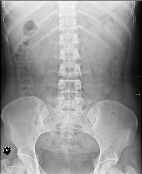 File:Medical X-Ray imaging CCN03 nevit.jpg