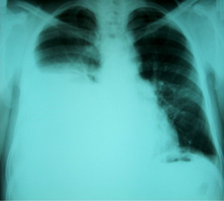 <span class="mw-page-title-main">Hepatic hydrothorax</span> Medical condition