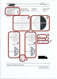 Figure 4 - Analyser Printout
1: Reliability Indices
2: Numerical Display
3: Grey Scale
4: Total Deviation
5: Probability Display
6: Pattern Deviation
7: Global Indices
8: Glaucoma Hemifield Test
9: Visual Field Index Plots2.jpg