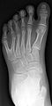 Radiographie de face du pied gauche d'un enfant atteint de polydactylie.