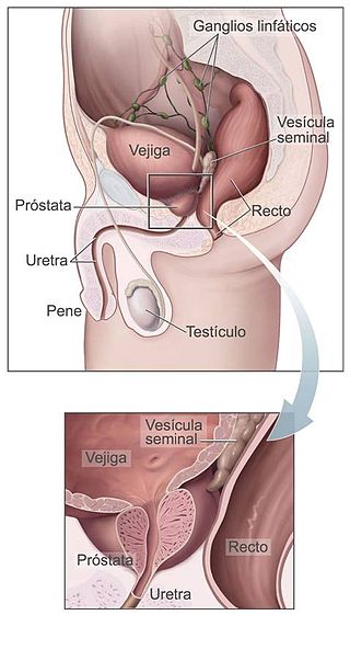 estadísticas de cáncer de próstata 2023