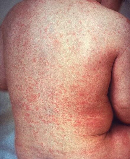 A rash due to rubella on a child's back. The area affected is similar to that of measles but the rash is less intensely red.