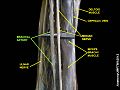 Arteria brachiale