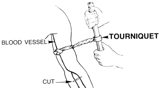  Tourniquet (PSF) 