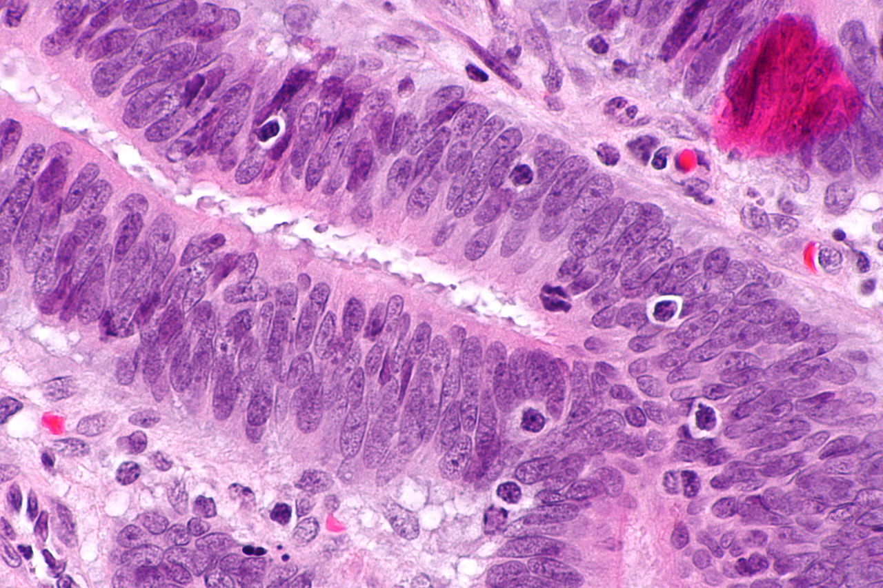 Limfocyty naciekające guz 