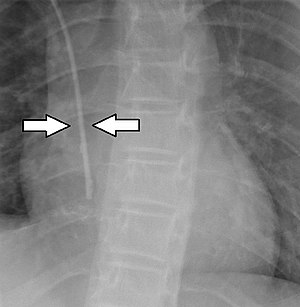 X-ray of a central venous catheter.jpg