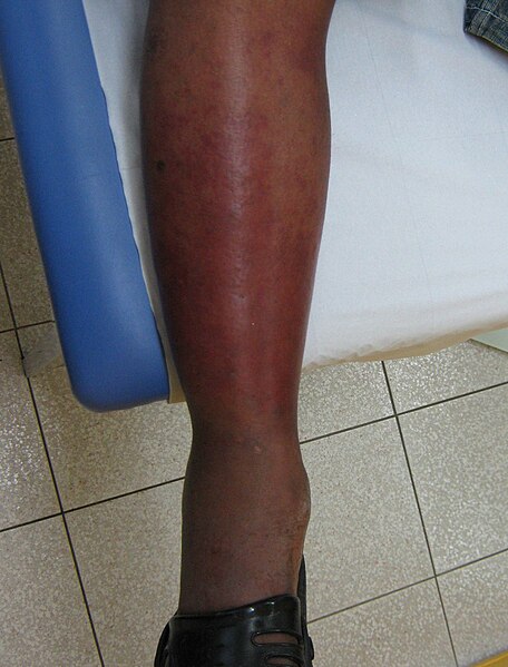 File:Érysipèle jambe- Leg erysipelas.jpg