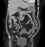 CT scan of a cecal volvulus