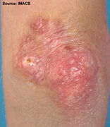 Gottron's papules on the elbows of a person with juvenile DM