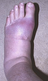 Gout in foot.jpg
