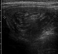 Intussusception