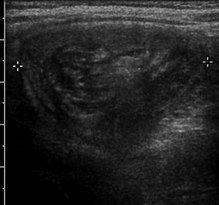 Intussusception Medical Disorder Wikipedia