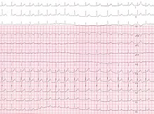 JEt (CardioNetworks ECGpedia).jpg