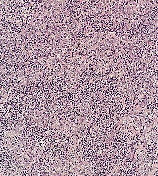 <span class="mw-page-title-main">Lymphoepithelioma</span> Medical condition