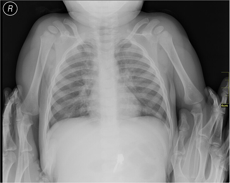 File:Medical X-Ray imaging PTO06 nevit.jpg