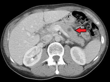Metastases from the lungs to the pancreas
