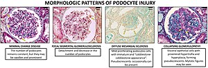 Morphologic patterns of podocyte injury. Morphologic patterns of podocyte injury.jpg