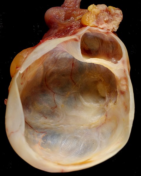 File:Mucinous Cystadenoma of Ovary (218889489).jpg