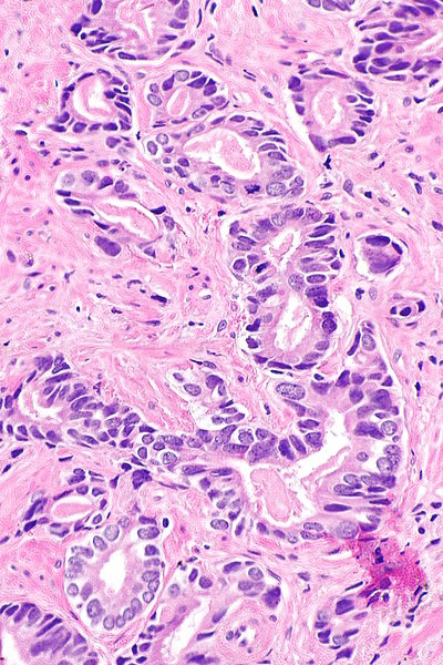File:Prostate carcinoma with NEC - conv only -- high mag.jpg