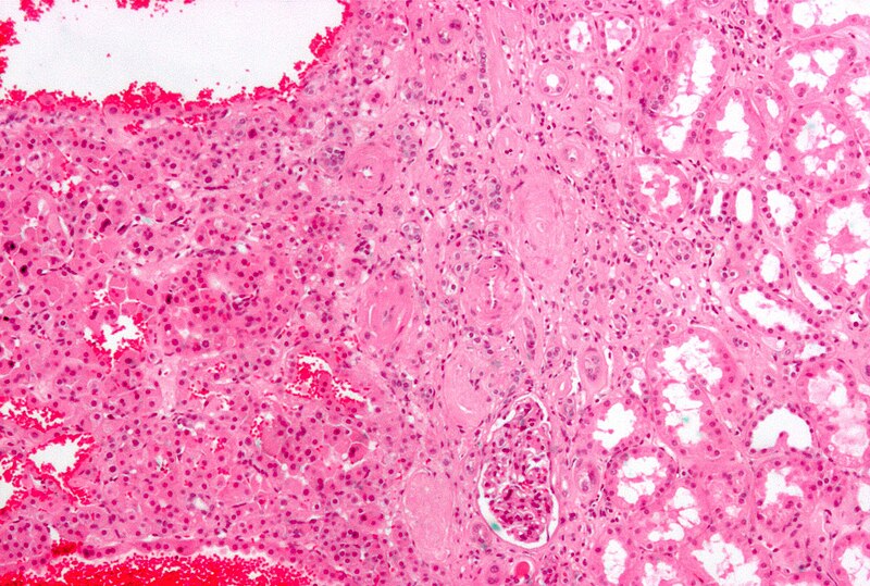 File:Renal oncocytoma3.jpg