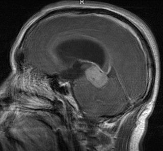 Tumor Germinoma PinealGland2.JPG