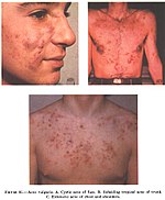 Različite vrste akni (Acne Vulgaris): A: Cistične akne na licu, B: Akne na trbuhu, V: Akne na grudima i ramenima.