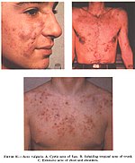 Различите врсте акни (Acne Vulgaris): A: Цистичне акне на лицу, Б: Акне на трбуху, В: Акне на грудима и раменима.