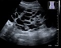USG zobrazení polycystické ledviny