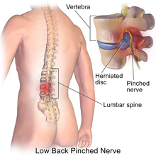 https://upload.wikimedia.org/wikipedia/commons/thumb/d/da/Blausen_0484_HerniatedLumbarDisc.png/220px-Blausen_0484_HerniatedLumbarDisc.png